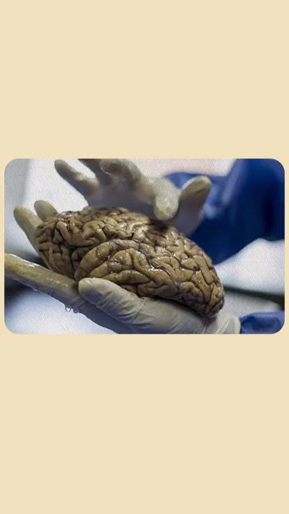 07082025_Litio_Alzheimer