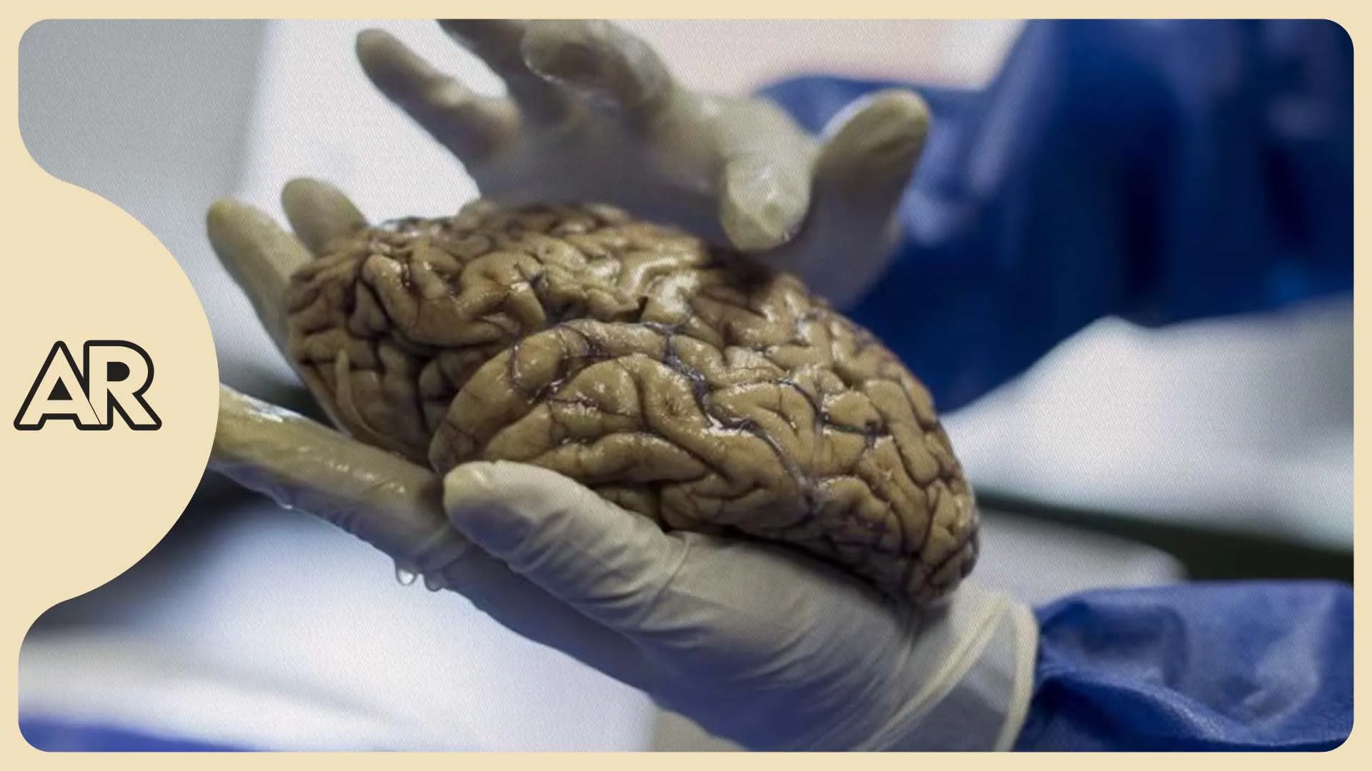 Estudio de Harvard sugiere que la deficiencia de litio podría ser una causa del Alzheimer