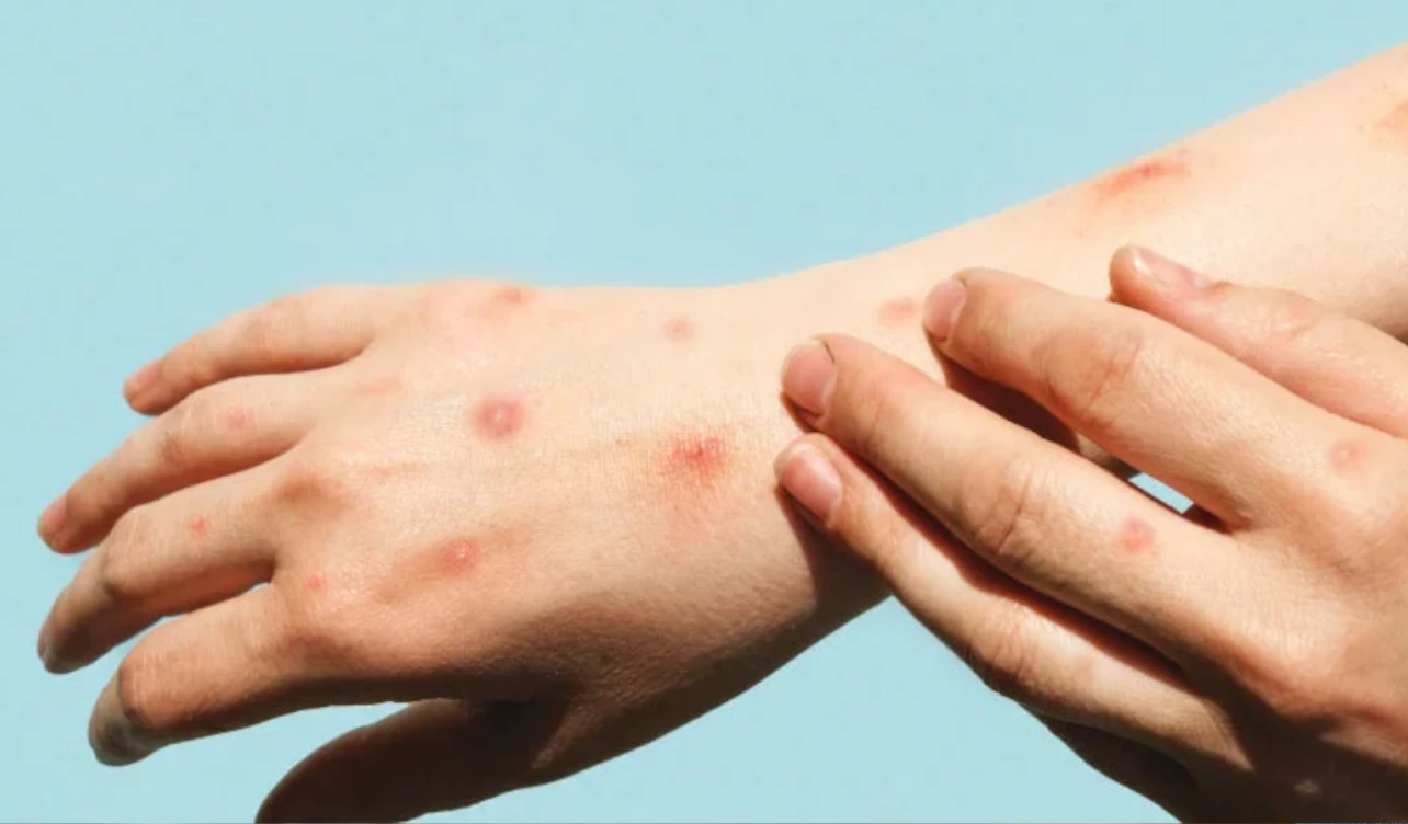 viruela símica mpox