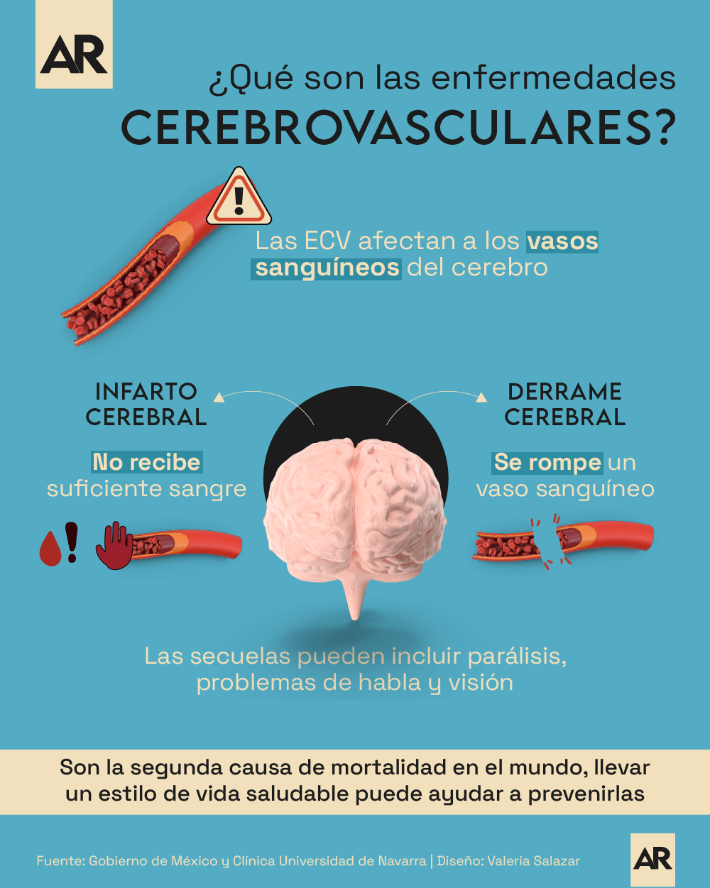 Cerebro, Vasos Capilares, Enfermedades, Derrame